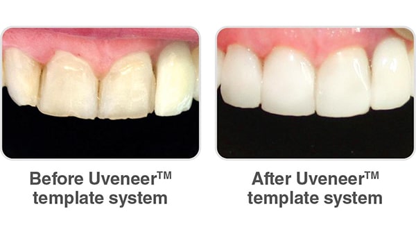 uveneer carillas composite ultradent ecuador (3)